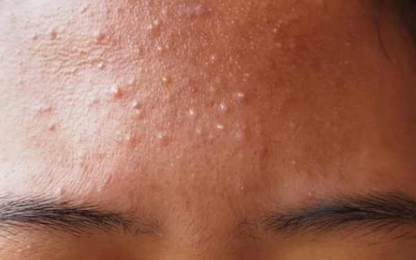 Thumbnail Berita - Ini Ciri-Ciri Lengkap Fungal Acne, Bukan Jerawat Biasa