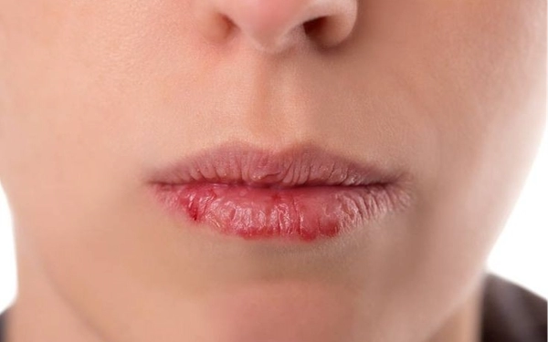 Agar Tetap Lembap, Simak Tips Cara Mengatasi Bibir Kering