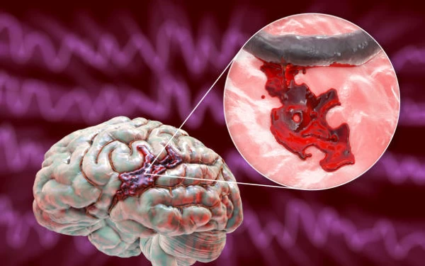 Kenali 5 Penyebab Pendarahan Otak untuk Hindari Stroke