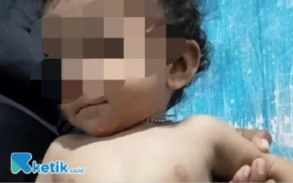 Thumbnail Berita - Ayo Bantu Muhammad Arzaka Anak Usia 1 Tahun Pengidap Stomakolostomi